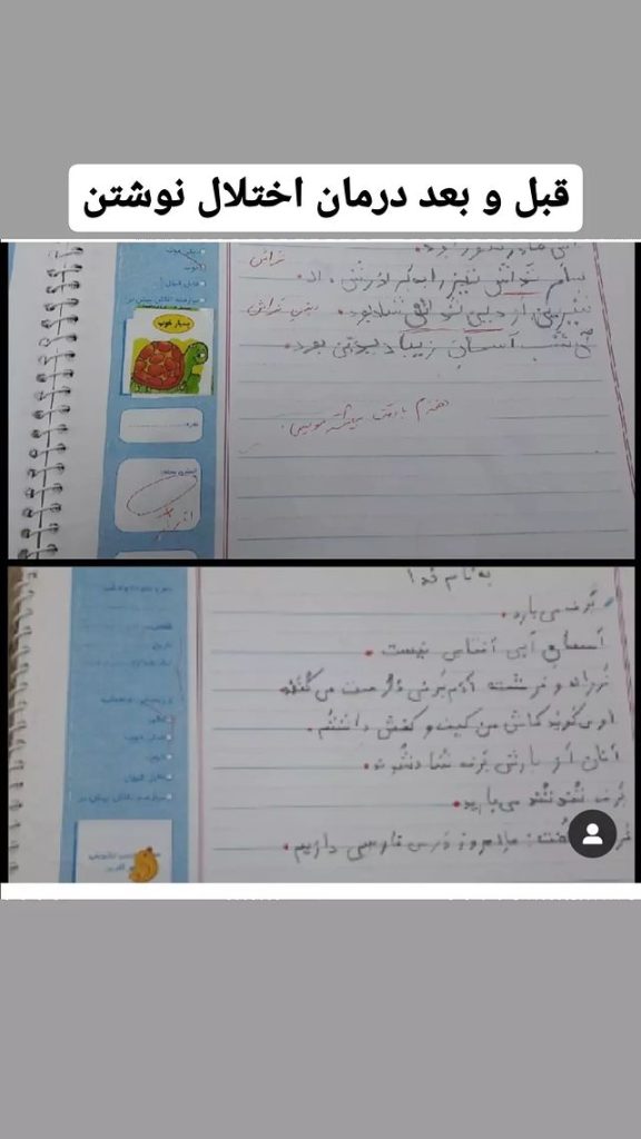 قبل و بعد - درمان اختلال نوشتن
